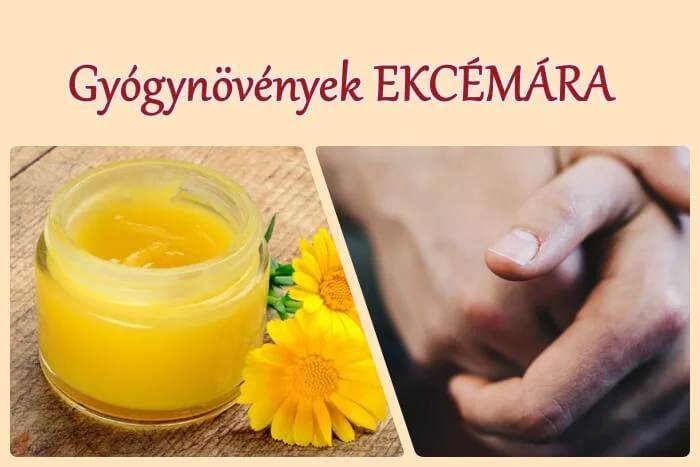 Gyógynövény ekcémára: 5+1 is segíthet, receptekkel!